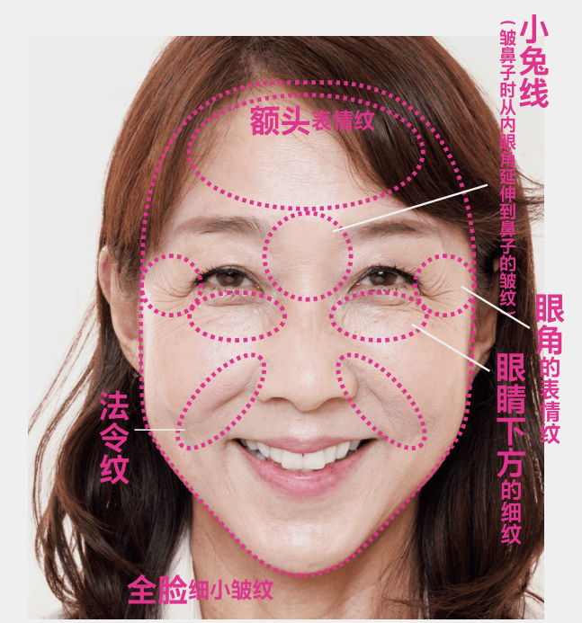 醫療美容 | 表情紋、眼周紋、法令紋，針對性改善！
