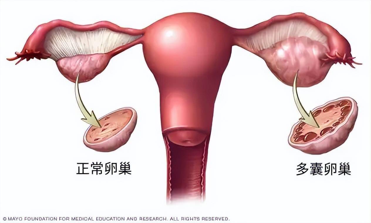 終於改名！這個病困擾全球1.7億女性，卻被“叫錯”90年